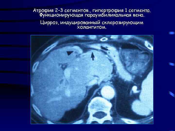 Атрофия 2 -3 сегментов. , гипертрофия 1 сегмента. Функционирующая параумбиликальная вена. Цирроз, индуцированный склерозирующим