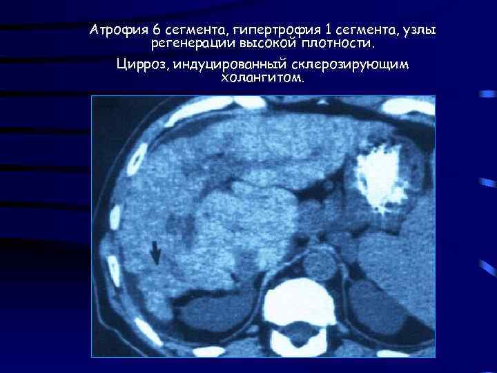 Атрофия 6 сегмента, гипертрофия 1 сегмента, узлы регенерации высокой плотности. Цирроз, индуцированный склерозирующим холангитом.