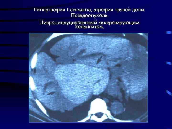 Гипертрофия 1 сегмента, атрофия правой доли. Псевдоопухоль. Цирроз, индуцированный склерозирующим холангитом. 