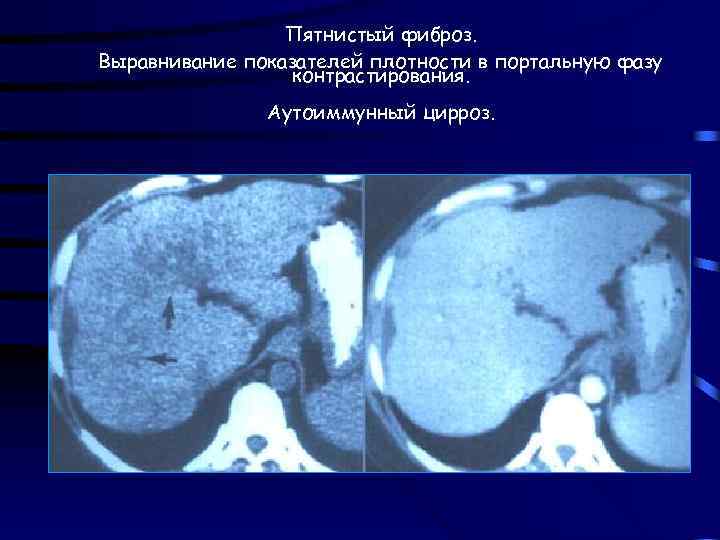 Пятнистый фиброз. Выравнивание показателей плотности в портальную фазу контрастирования. Аутоиммунный цирроз. 