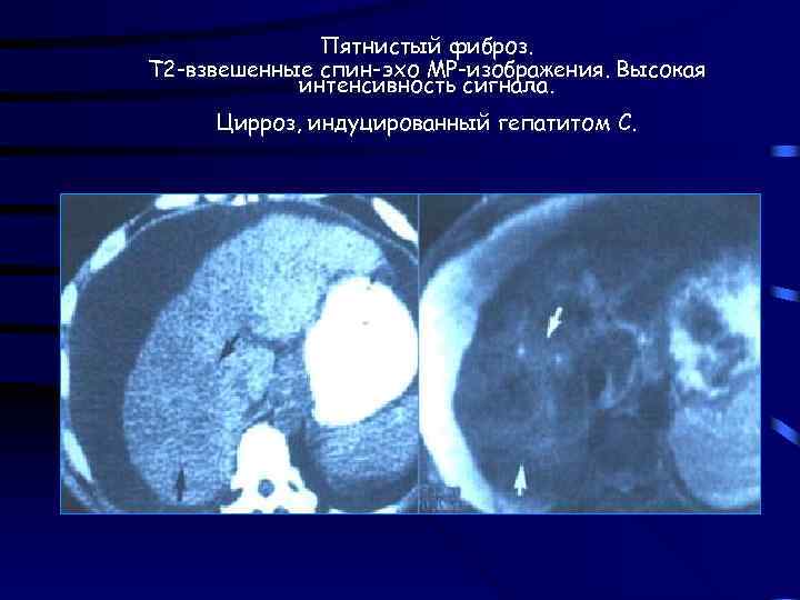 Пятнистый фиброз. Т 2 -взвешенные спин-эхо МР-изображения. Высокая интенсивность сигнала. Цирроз, индуцированный гепатитом С.