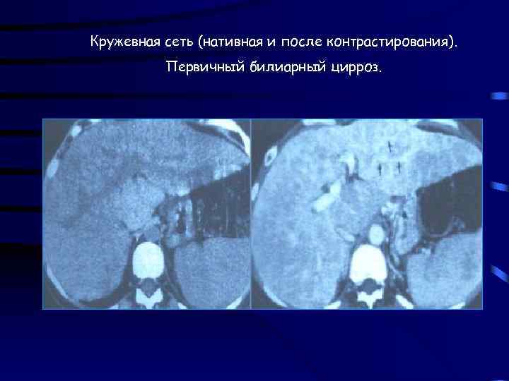 Кружевная сеть (нативная и после контрастирования). Первичный билиарный цирроз. 