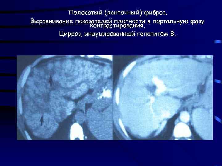 Полосатый (ленточный) фиброз. Выравнивание показателей плотности в портальную фазу контрастирования. Цирроз, индуцированный гепатитом В.