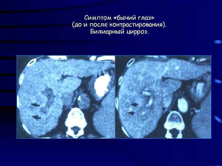 Симптом «бычий глаз» (до и после контрастирования). Билиарный цирроз. 
