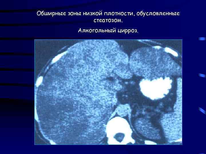 Обширные зоны низкой плотности, обусловленные стеатозом. Алкогольный цирроз. 