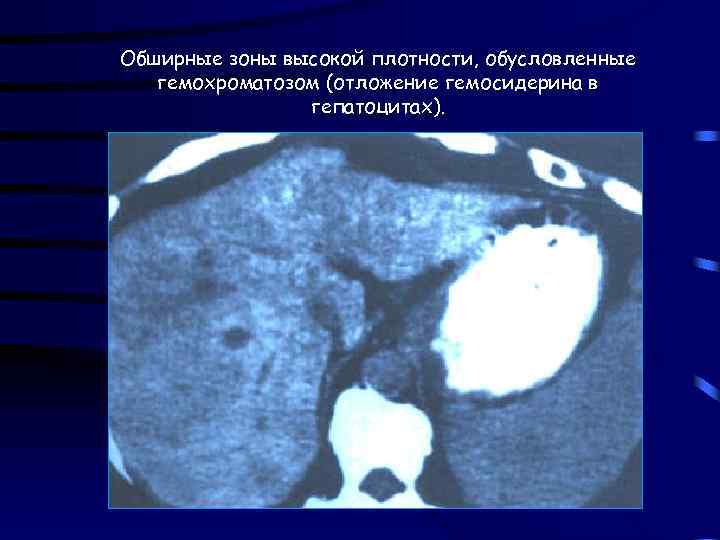 Обширные зоны высокой плотности, обусловленные гемохроматозом (отложение гемосидерина в гепатоцитах). 