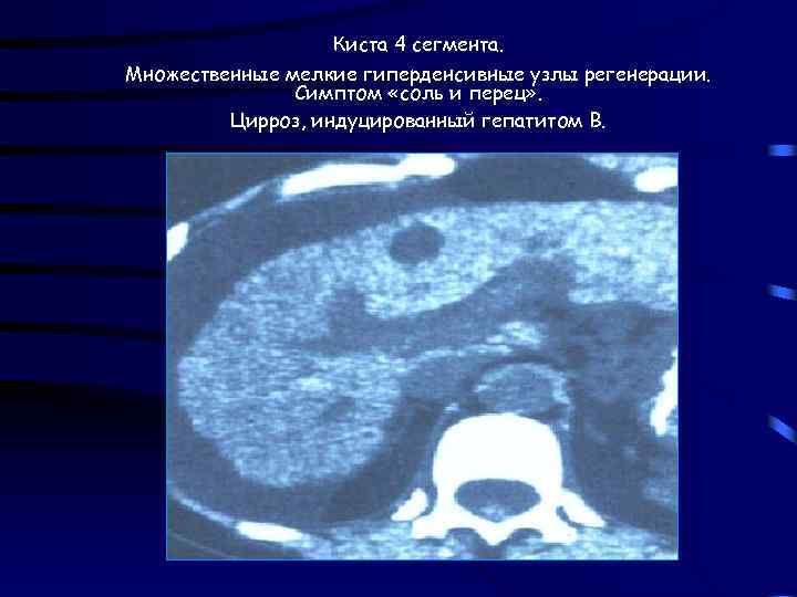 Киста 4 сегмента. Множественные мелкие гиперденсивные узлы регенерации. Симптом «соль и перец» . Цирроз,