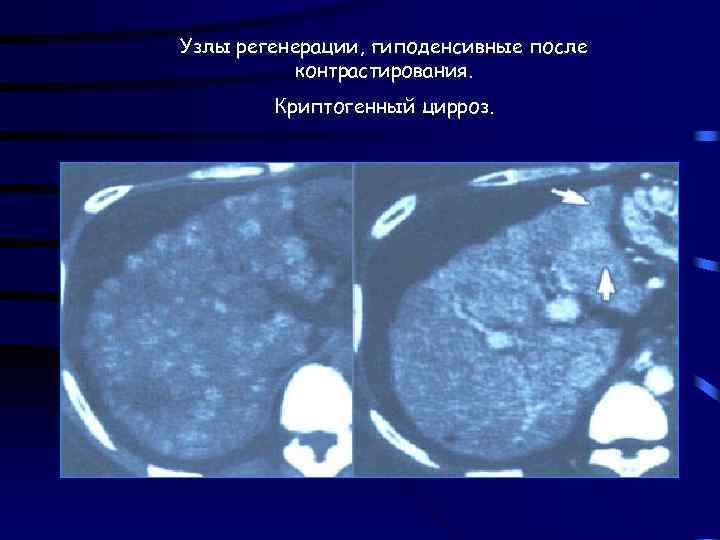 Узлы регенерации, гиподенсивные после контрастирования. Криптогенный цирроз. 