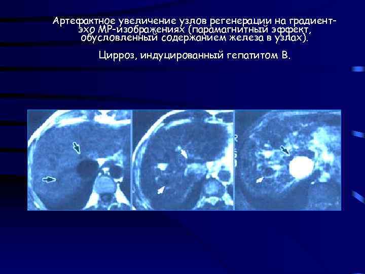 Артефактное увеличение узлов регенерации на градиентэхо МР-изображениях (парамагнитный эффект, обусловленный содержанием железа в узлах).