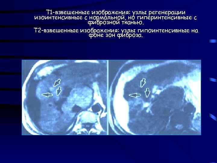 Т 1 -взвешенные изображения: узлы регенерации изоинтенсивные с нормальной, но гиперинтенсивные с фиброзной тканью.