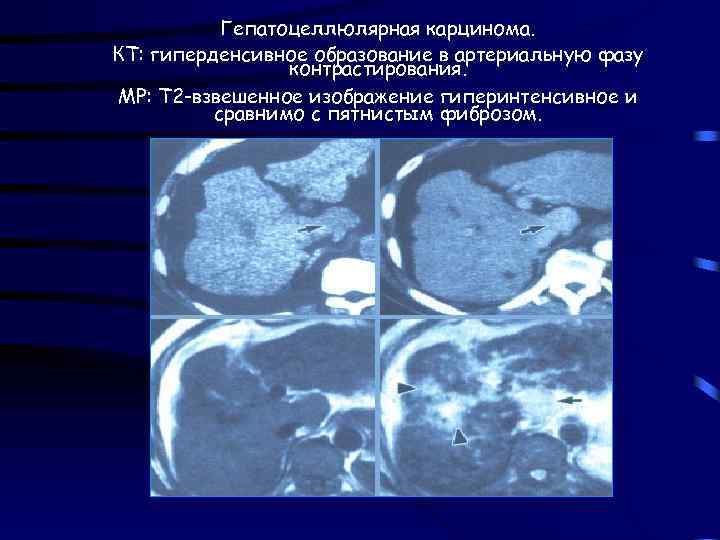 Гепатоцеллюлярная карцинома. КТ: гиперденсивное образование в артериальную фазу контрастирования. МР: Т 2 -взвешенное изображение