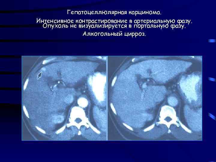 Гепатоцеллюлярная карцинома. Интенсивное контрастирование в артериальную фазу. Опухоль не визуализируется в портальную фазу. Алкогольный