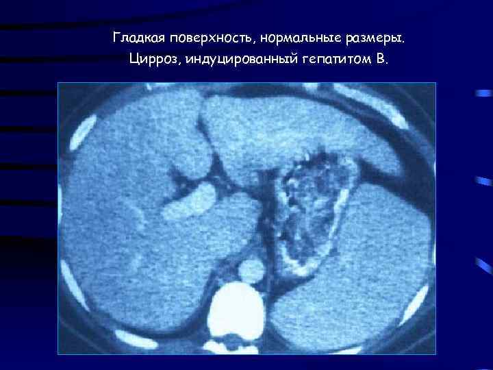 Гладкая поверхность, нормальные размеры. Цирроз, индуцированный гепатитом В. 