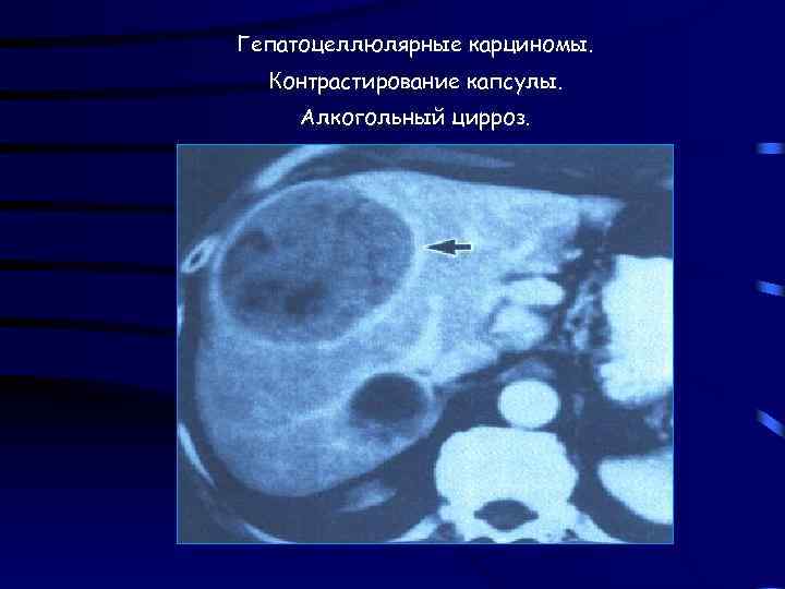 Гепатоцеллюлярные карциномы. Контрастирование капсулы. Алкогольный цирроз. 