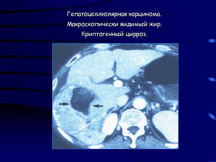 Гепатоцеллюлярная карцинома. Макроскопически видимый жир. Криптогенный цирроз. 