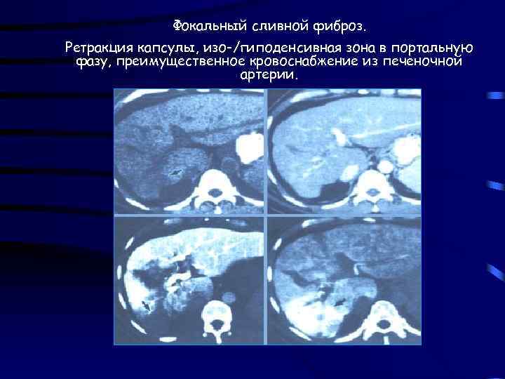 Фокальный сливной фиброз. Ретракция капсулы, изо-/гиподенсивная зона в портальную фазу, преимущественное кровоснабжение из печеночной