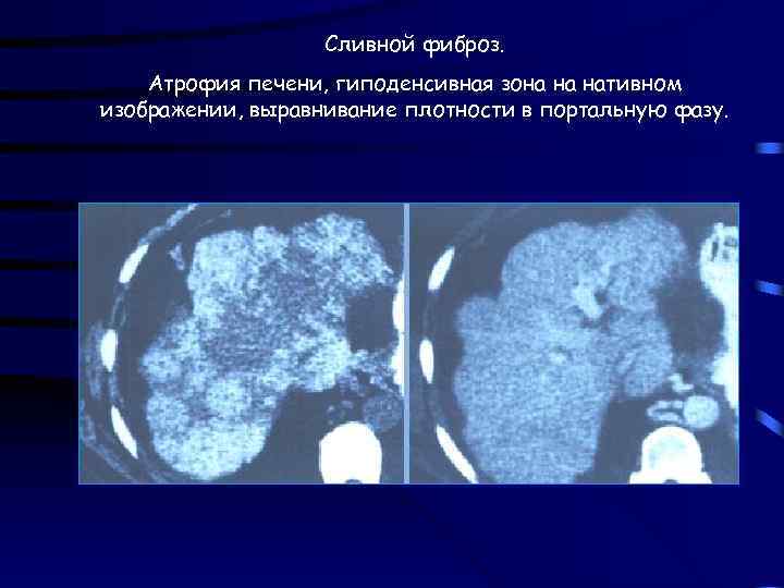 Сливной фиброз. Атрофия печени, гиподенсивная зона на нативном изображении, выравнивание плотности в портальную фазу.