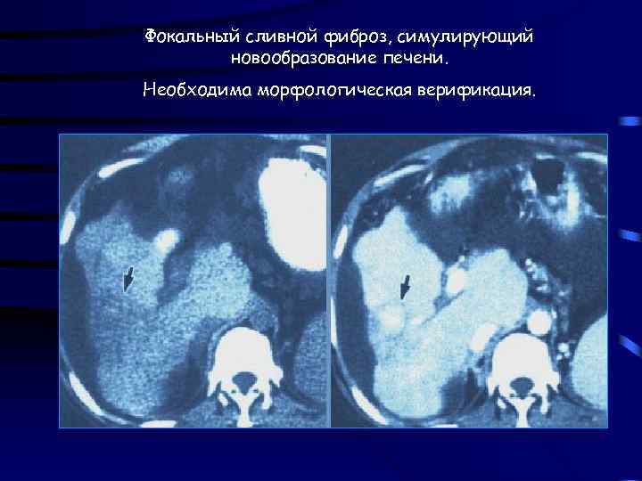 Фокальный сливной фиброз, симулирующий новообразование печени. Необходима морфологическая верификация. 