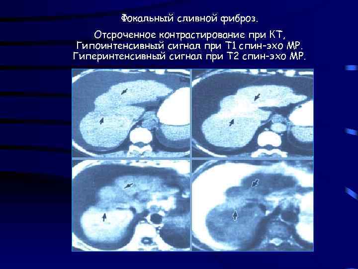 Фокальный сливной фиброз. Отсроченное контрастирование при КТ, Гипоинтенсивный сигнал при Т 1 спин-эхо МР.