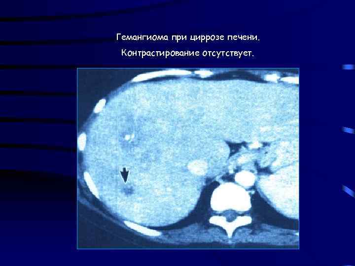 Гемангиома при циррозе печени. Контрастирование отсутствует. 