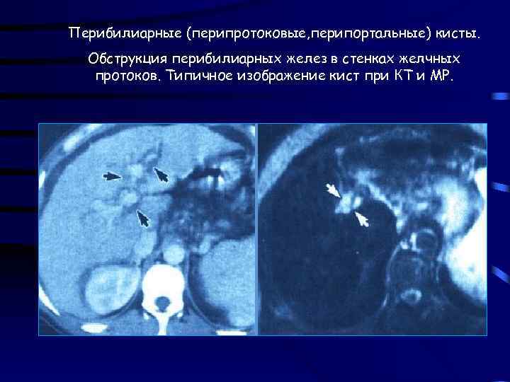 Перибилиарные (перипротоковые, перипортальные) кисты. Обструкция перибилиарных желез в стенках желчных протоков. Типичное изображение кист