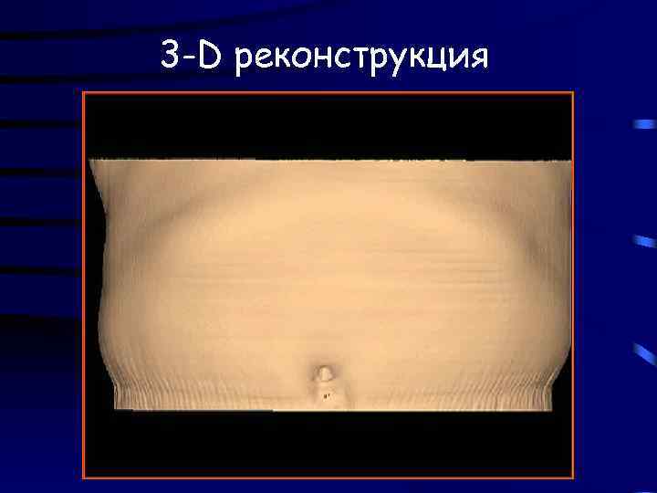 3 -D реконструкция 