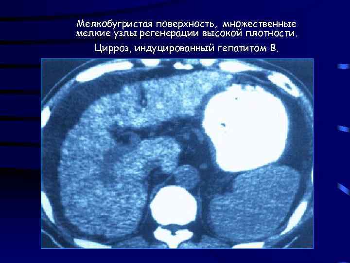 Мелкобугристая поверхность, множественные мелкие узлы регенерации высокой плотности. Цирроз, индуцированный гепатитом В. 