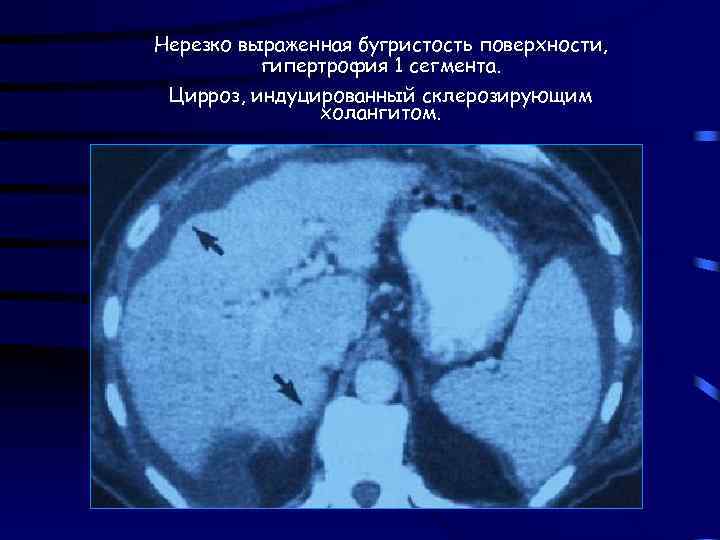 Нерезко выраженная бугристость поверхности, гипертрофия 1 сегмента. Цирроз, индуцированный склерозирующим холангитом. 