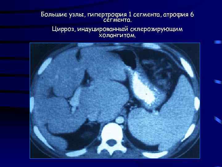 Большие узлы, гипертрофия 1 сегмента, атрофия 6 сегмента. Цирроз, индуцированный склерозирующим холангитом. 