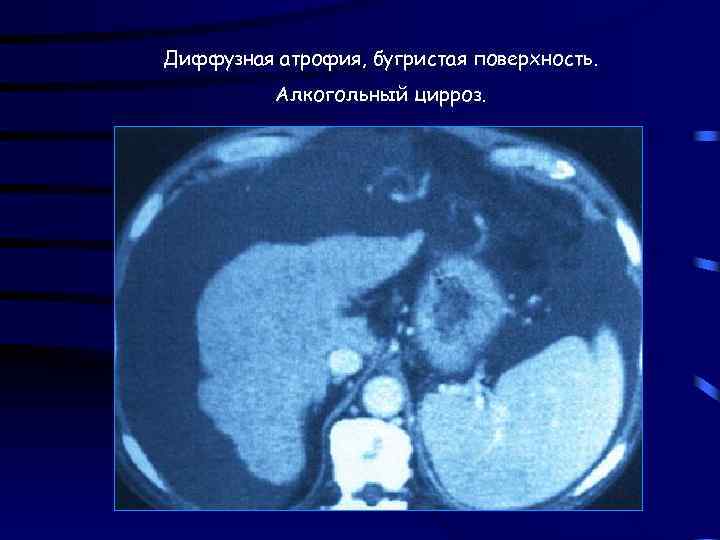 Диффузная атрофия, бугристая поверхность. Алкогольный цирроз. 