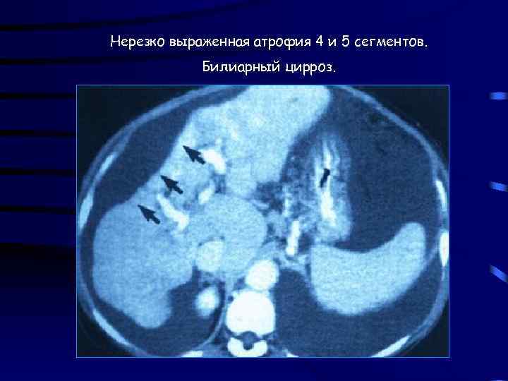 Нерезко выраженная атрофия 4 и 5 сегментов. Билиарный цирроз. 