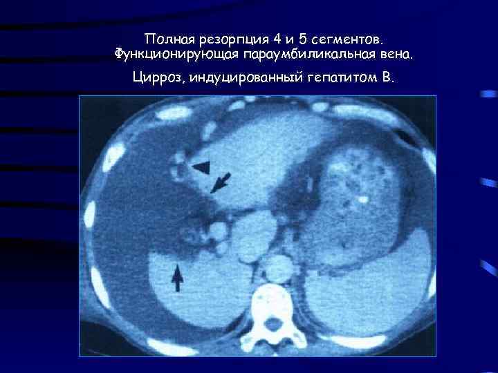 Полная резорпция 4 и 5 сегментов. Функционирующая параумбиликальная вена. Цирроз, индуцированный гепатитом В. 