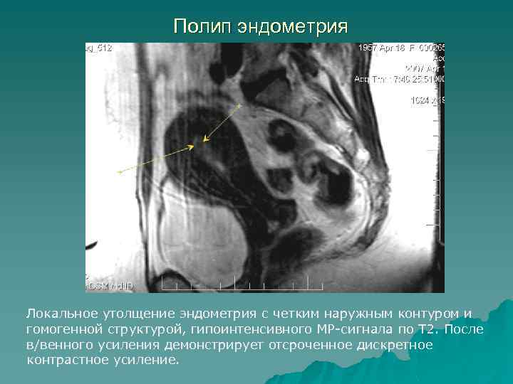 Полип эндометрия Локальное утолщение эндометрия с четким наружным контуром и гомогенной структурой, гипоинтенсивного МР-сигнала