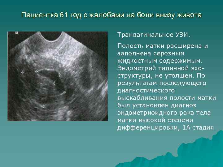 Эндометрий 24. Расширенная полость матки на УЗИ. Полость матки 7мм расширена до 7 мм. Расширение полости матки на УЗИ.