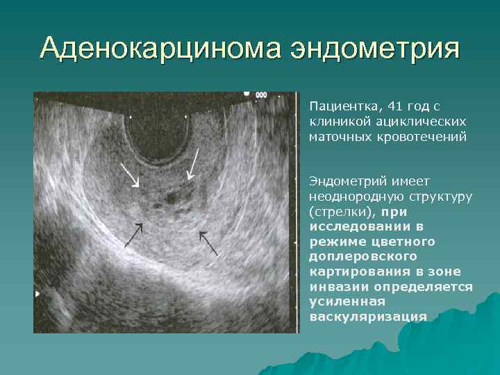 Ультразвуковые критерии гиперплазии эндометрия. Неоднородность эндометрия на УЗИ что это. Эндометрий структура однородная.
