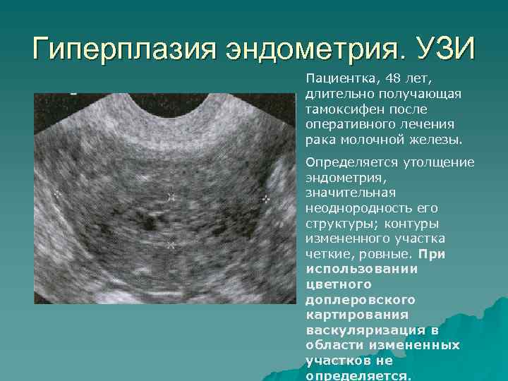 Эндометрий 16 мм. Атипическая гиперплазия эндометрия УЗИ. УЗИ признаки гиперплазии эндометрия. Гиперплазия эндометрия на УЗИ. Гиперплазия эндометрия матки на УЗИ.