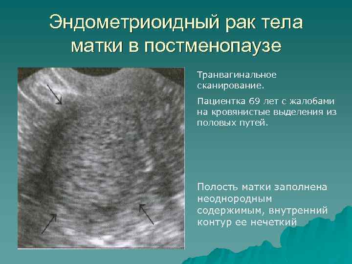 Эндометрия 3 мм. Эндометриоидные кисты яичника на УЗИ. Карцинома эндометрия матки УЗИ. Эндометриоидные опухоли.