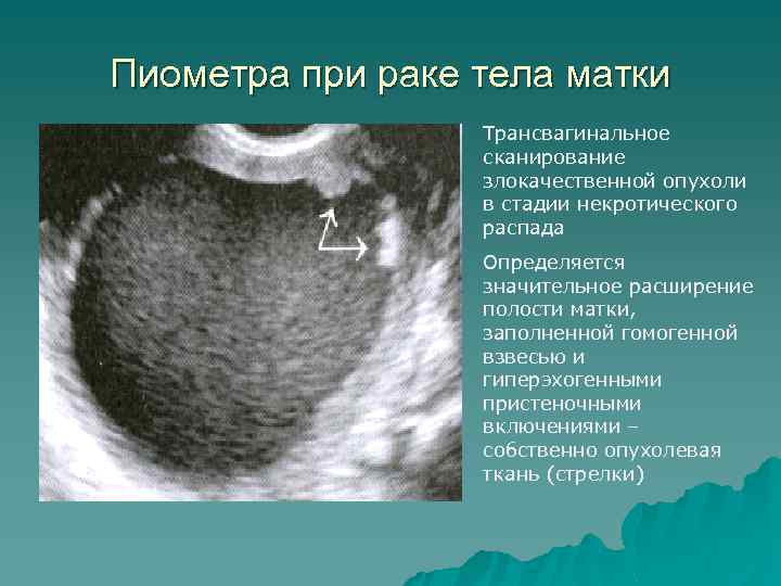 Пиометра при раке тела матки Трансвагинальное сканирование злокачественной опухоли в стадии некротического распада Определяется