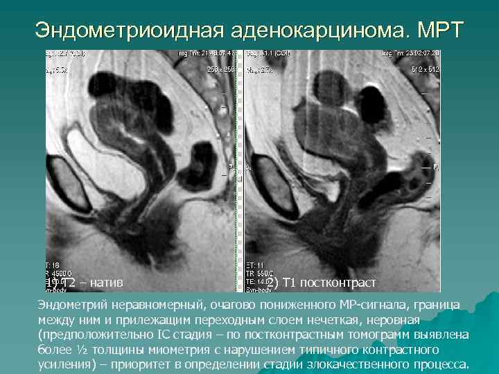 Эндометриоидная аденокарцинома. МРТ 1) Т 2 – натив 2) Т 1 постконтраст Эндометрий неравномерный,