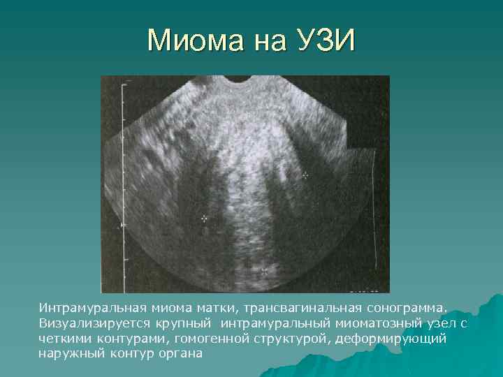 Миома на УЗИ Интрамуральная миома матки, трансвагинальная сонограмма. Визуализируется крупный интрамуральный миоматозный узел с