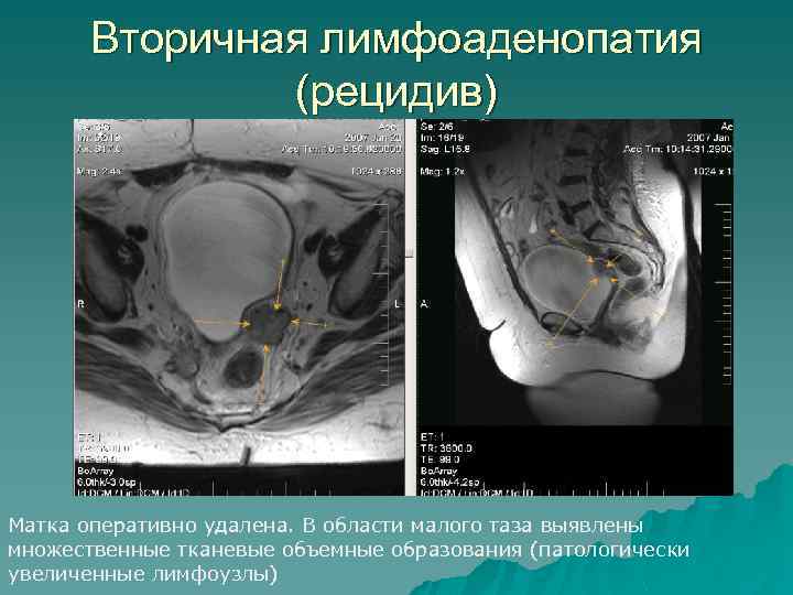 Вторичная лимфоаденопатия (рецидив) Матка оперативно удалена. В области малого таза выявлены множественные тканевые объемные