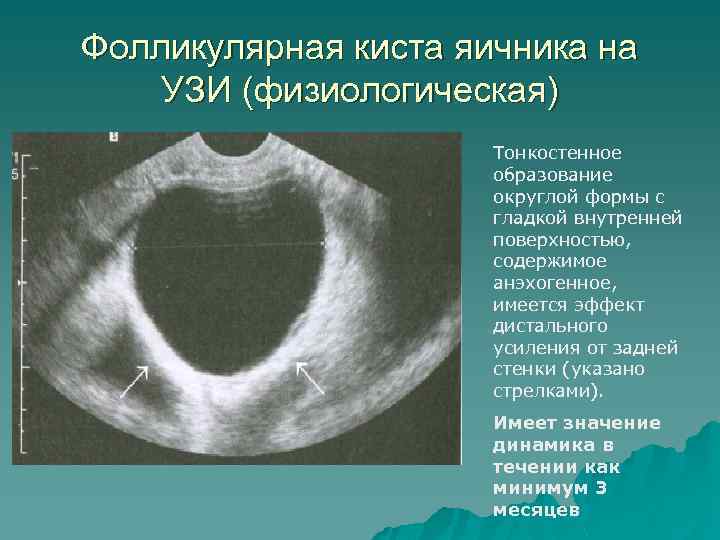 Фолликулярная киста яичника на УЗИ (физиологическая) Тонкостенное образование округлой формы с гладкой внутренней поверхностью,