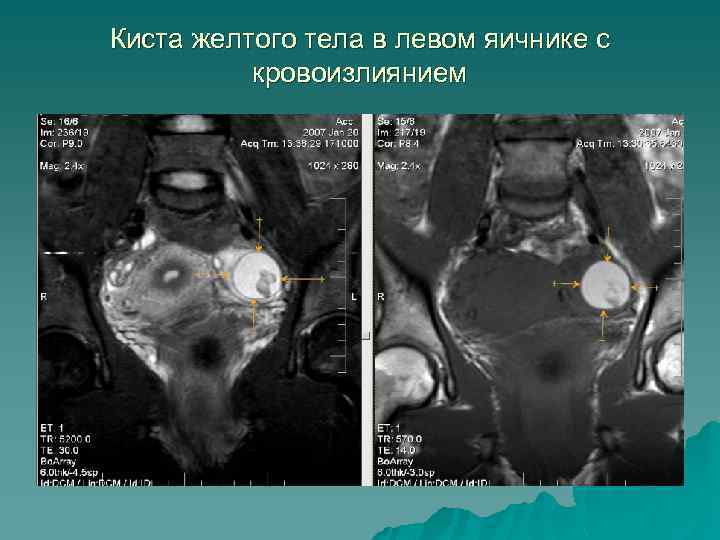 Киста желтого тела в левом яичнике с кровоизлиянием 