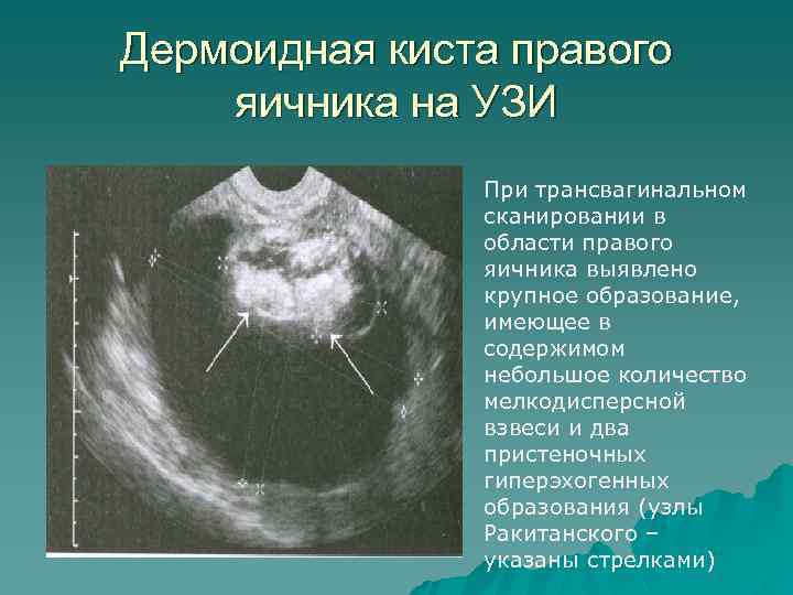 Дермоидная киста правого яичника на УЗИ При трансвагинальном сканировании в области правого яичника выявлено