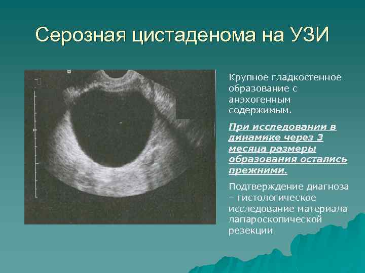 Серозная цистаденома на УЗИ Крупное гладкостенное образование с анэхогенным содержимым. При исследовании в динамике