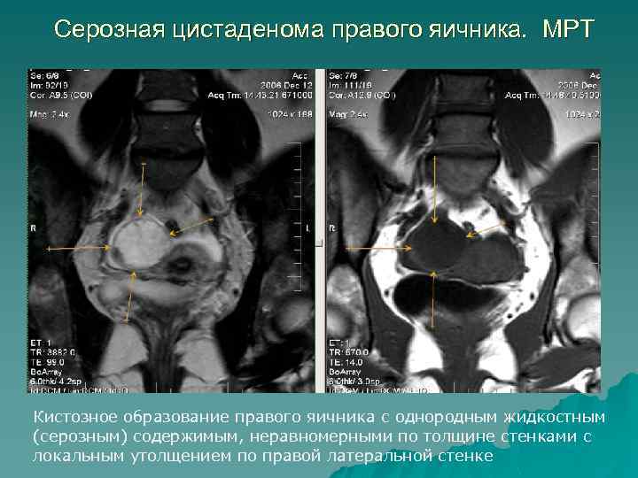 Серозная цистаденома правого яичника. МРТ Кистозное образование правого яичника с однородным жидкостным (серозным) содержимым,