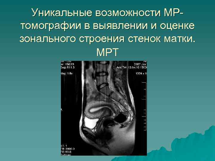 Уникальные возможности МРтомографии в выявлении и оценке зонального строения стенок матки. МРТ 