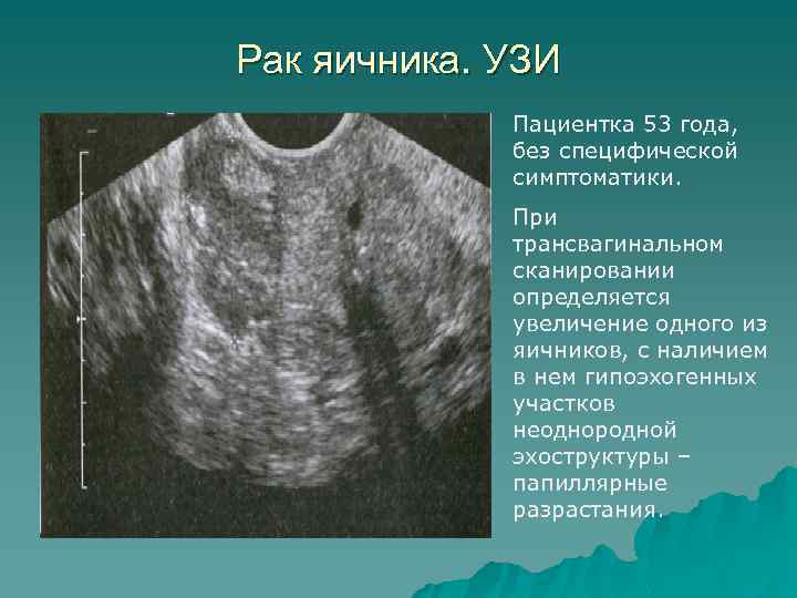 Эндометрия 7мм. Кистозно-Солидное образование яичника УЗИ. Солидное образование яичника на УЗИ. Злокачественная опухоль яичника на УЗИ.