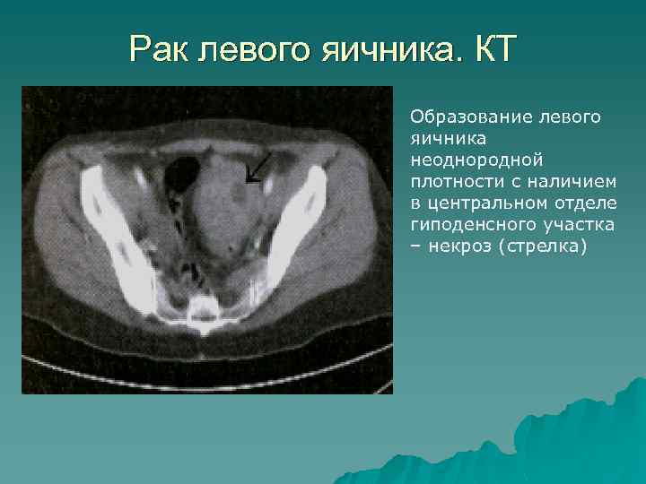 Рак левого яичника. КТ Образование левого яичника неоднородной плотности с наличием в центральном отделе