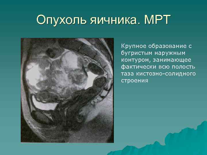 Опухоль яичника. МРТ Крупное образование с бугристым наружным контуром, занимающее фактически всю полость таза